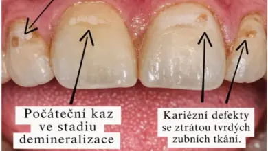 Zubní kaz na předních zubech s popisky v češtině.