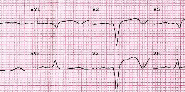 Elektrokardiogram ukazuje srdeční tep v různých odvedeních.
