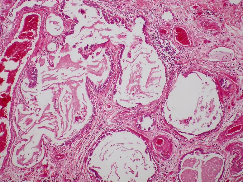 Histologický snímek plicní fibrózy s hustou kolagénovou tkání.
