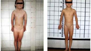 Dvě fotografie dětí s Turnerovým syndromem pro ilustraci příznaků.