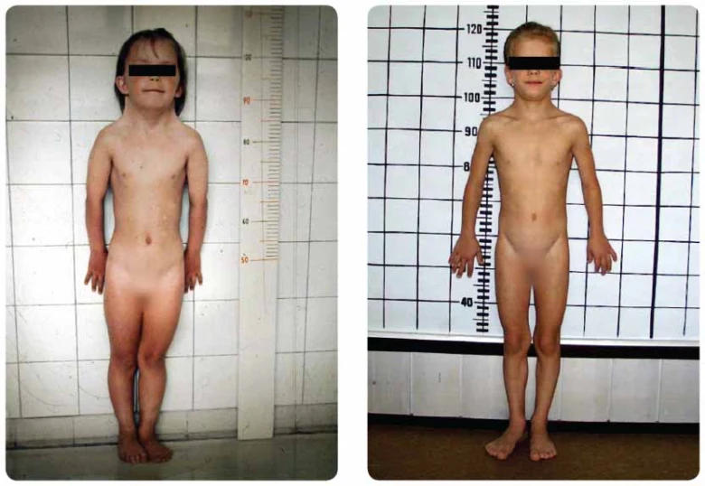 Dvě fotografie dětí s Turnerovým syndromem pro ilustraci příznaků.
