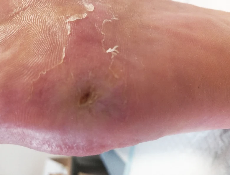 Fotografie diabetické nohy s vředem a zánětem kůže.