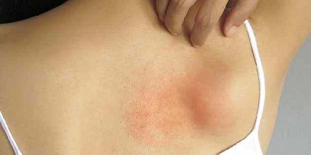 Červená vyrážka na kůži zad způsobená kontaktní dermatitidou.