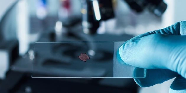 Ruka drží mikroskopický preparát s krví pro diagnostiku leukémie.