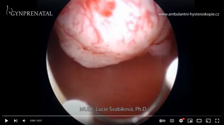 Uterine fibroid inside uterus