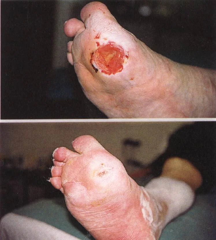 Diabetická rána na patě před a po léčbě.