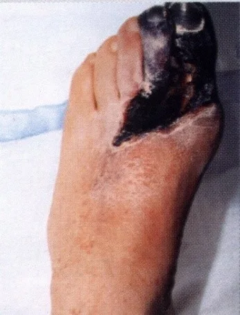Fotografie diabetické nohy s černou nekrózou prstů.