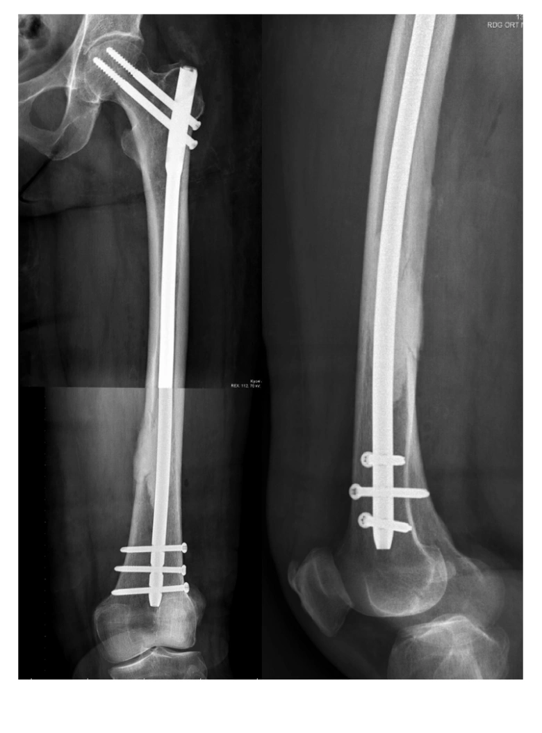 Rentgen snímek stehenní kosti s implantátem po operaci.